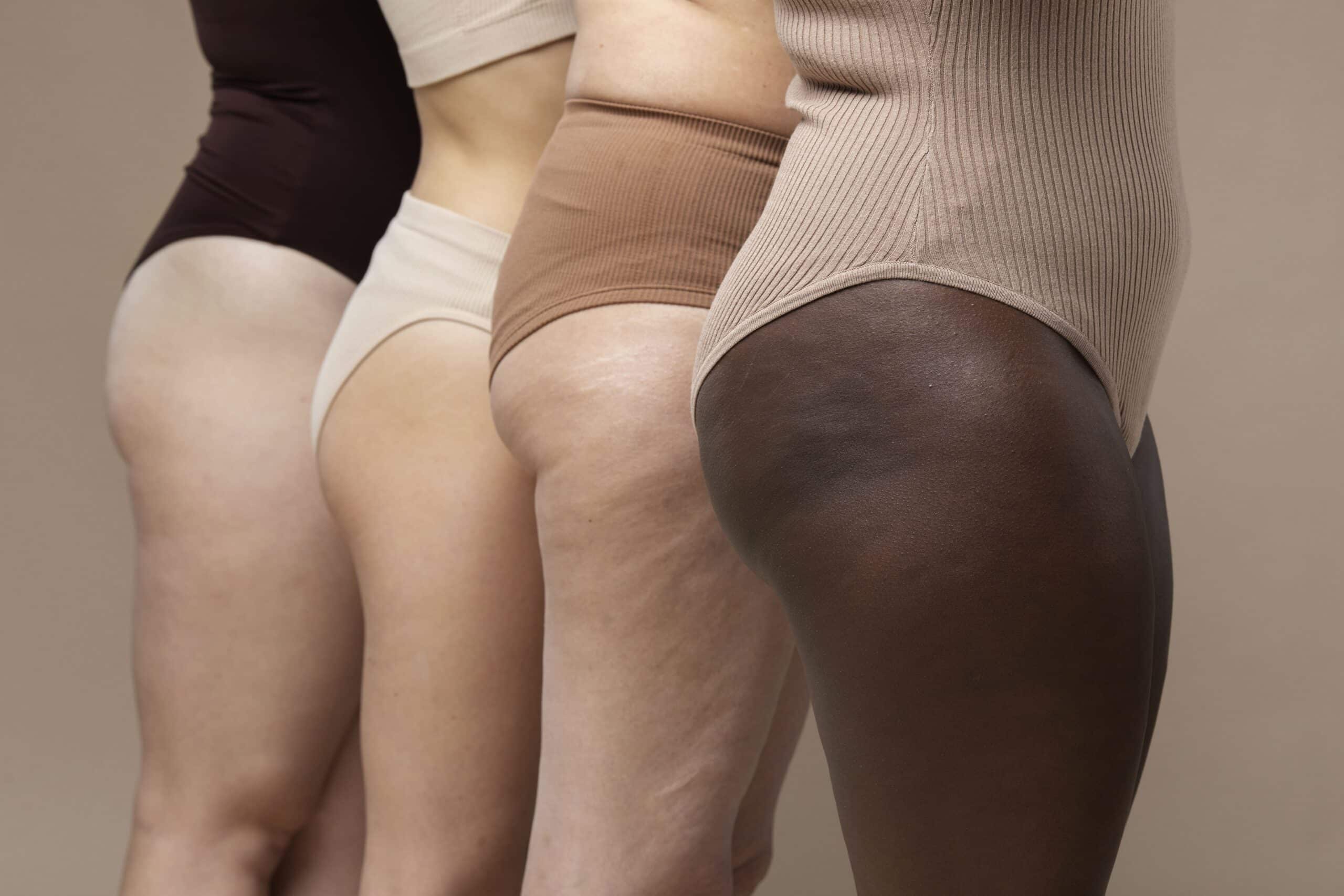 Vergetures rouges et blanches : peut-on vraiment les enlever ?